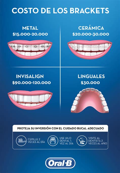 tipo de brackets metalicos|cuanto cuesta un bracket.